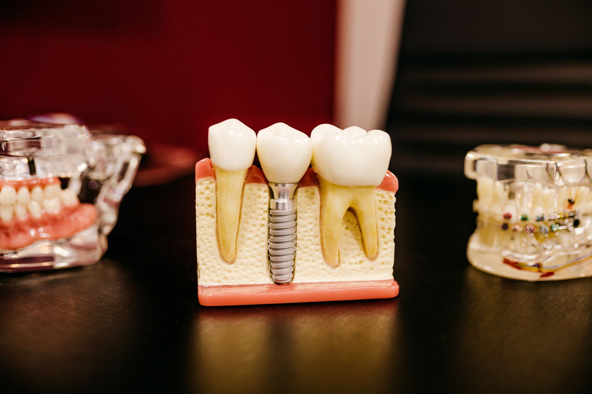 Modelos de reabilitação oral e implantes dentários em consultório